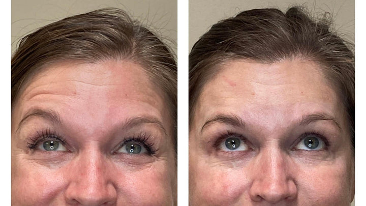 Patient's before and after botox pictures, forehead lines reduced and smoothed out