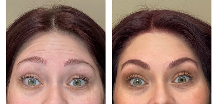 Patient's before and after pictures of Botox, showing forehead wrinkles that were smoothed out due to injections