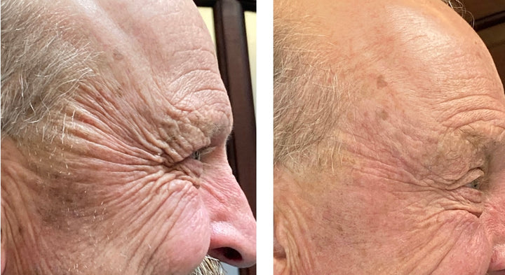 Older gentleman's before and after pictures for Jeuveau, large wrinkles and smile lines were significantly reduced down