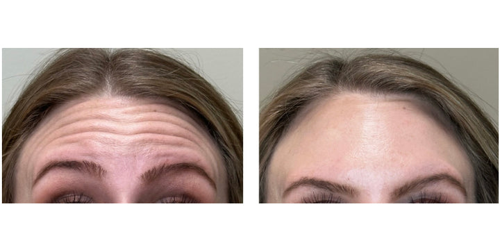 Patient's before and after pictures, showing forehead wrinkles that were smoothed out after injections