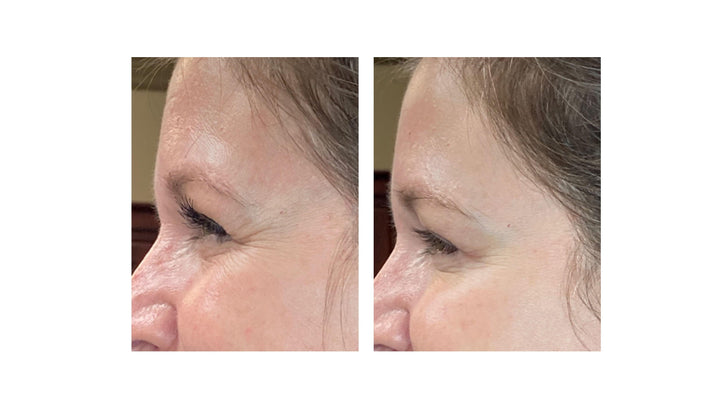 Patient's before and after pictures with botox, reducing frown lines and forehead wrinkles