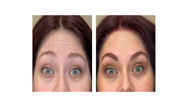Patient's before and after pictures with botox, reducing forehead wrinkles and smoothing out fine lines