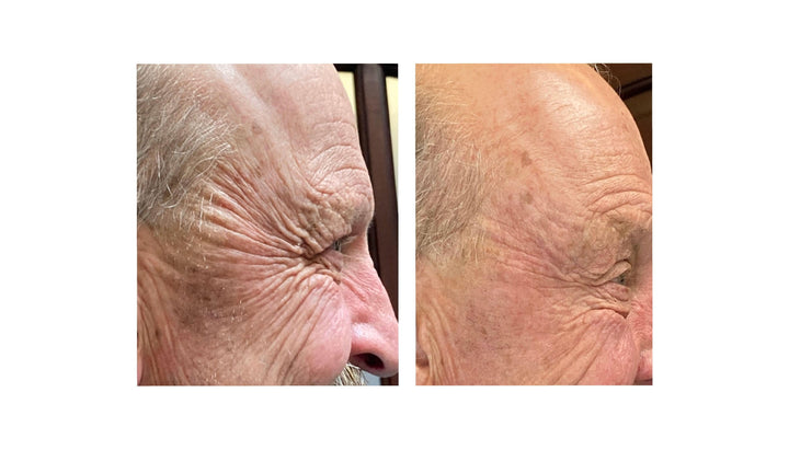 Patient's before and after pictures with Jeuveau, significantly reducing frown lines, crow's feet, and smoothing out fine lines