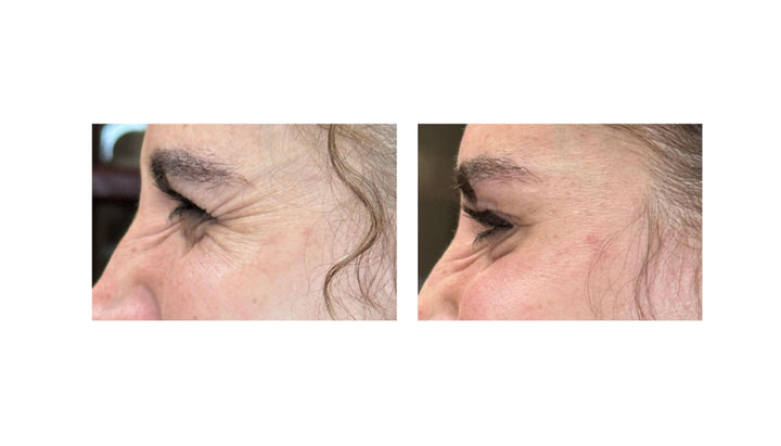 Patient's before and after pictures with Jeuveau, reducing crow's feet and smoothing out fine lines