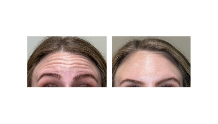 Patient's before and after pictures with Jeuveau, reducing forehead wrinkles and smoothing out fine lines