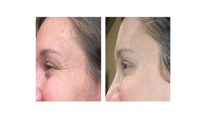 Patient's before and after pictures with Jeuveau, reducing crow's feet and smoothing out fine lines