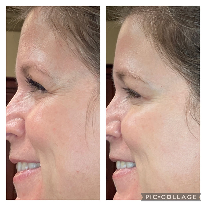 Patient's botox before and after pictures, smoothing out smile lines