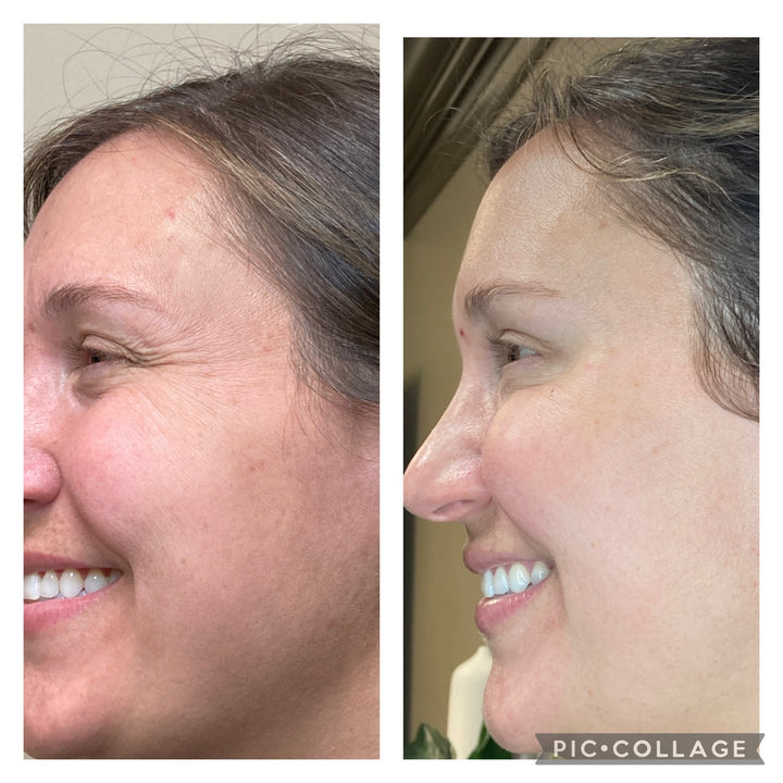 Patient's before and after pictures with Jeuveau, completely smoothing out smile lines
