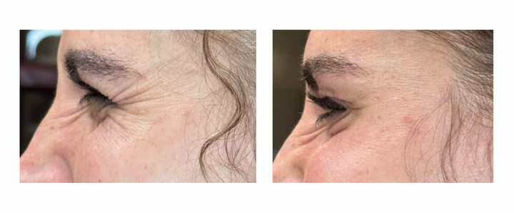 Before and after pictures for patient who had neurotoxin injections for "crow's feet" wrinkles, lines next to eyes smoothed out 