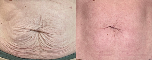 Morpheus skin tightening