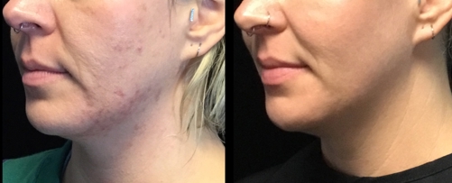 morpheus for acne scarring