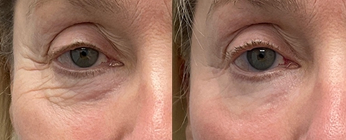 morpheus for under eyes